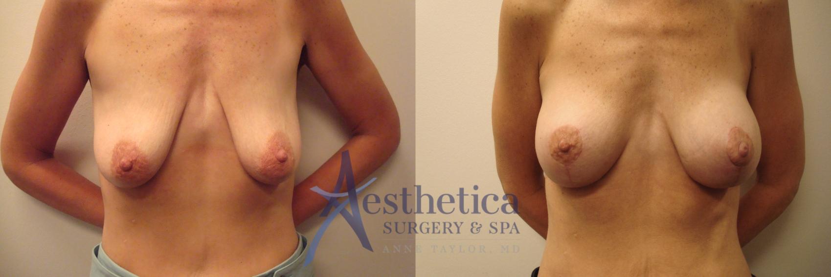Breast Augmentation Case 516 Before & After Front | Worthington, OH | Aesthetica Surgery & Spa