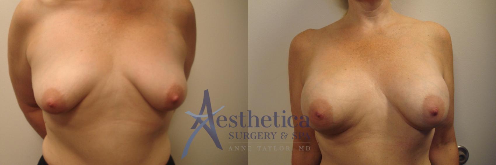 Breast Augmentation Case 530 Before & After Front | Worthington, OH | Aesthetica Surgery & Spa
