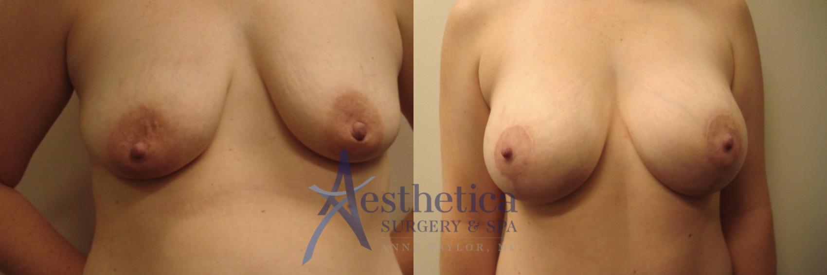Breast Augmentation Case 591 Before & After Front | Columbus, OH | Aesthetica Surgery & Spa