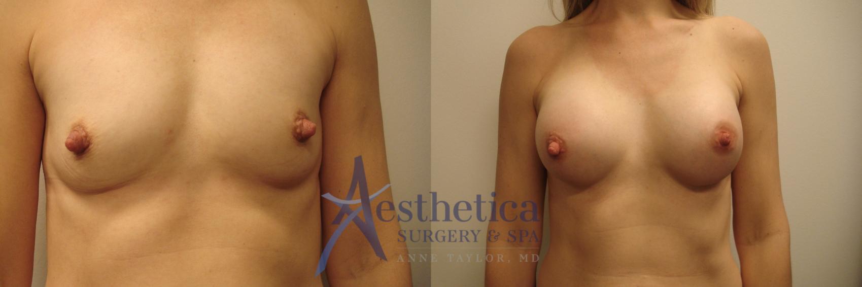 Breast Augmentation Case 593 Before & After Front | Columbus, OH | Aesthetica Surgery & Spa