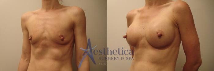 Breast Augmentation Case 615 Before & After Front | Columbus, OH | Aesthetica Surgery & Spa