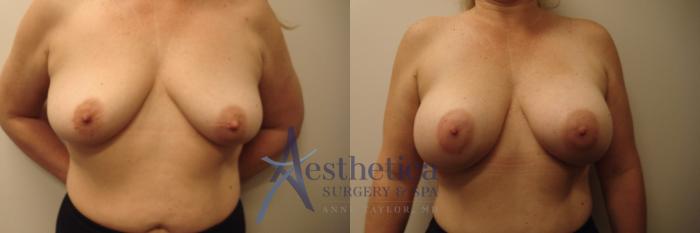 Breast Augmentation Case 617 Before & After Front | Columbus, OH | Aesthetica Surgery & Spa