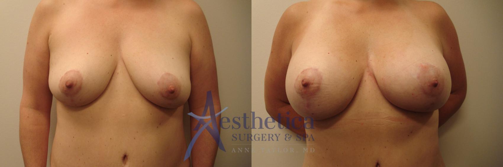 Breast Augmentation Case 624 Before & After Front | Columbus, OH | Aesthetica Surgery & Spa