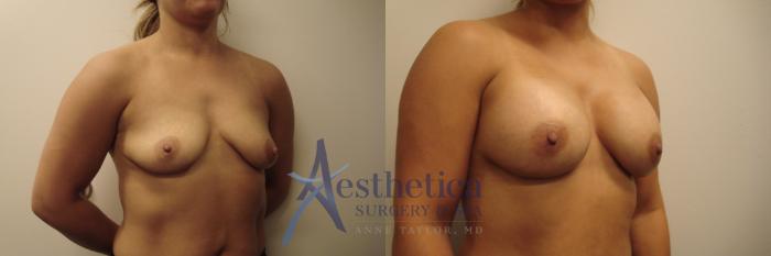 Breast Augmentation Case 631 Before & After Right Oblique | Columbus, OH | Aesthetica Surgery & Spa
