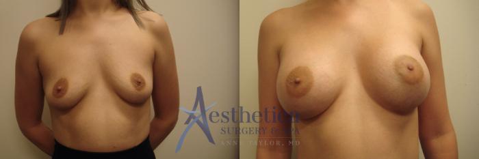 Breast Augmentation Case 636 Before & After Front | Columbus, OH | Aesthetica Surgery & Spa