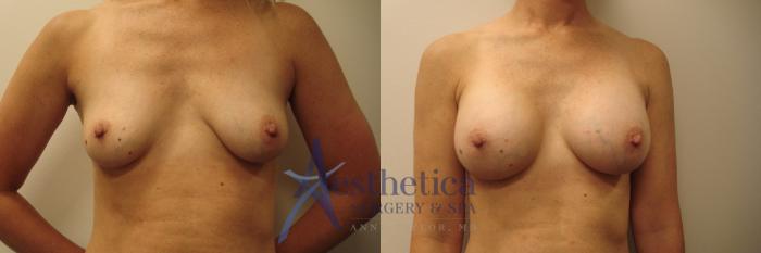 Breast Augmentation Case 649 Before & After Front | Columbus, OH | Aesthetica Surgery & Spa
