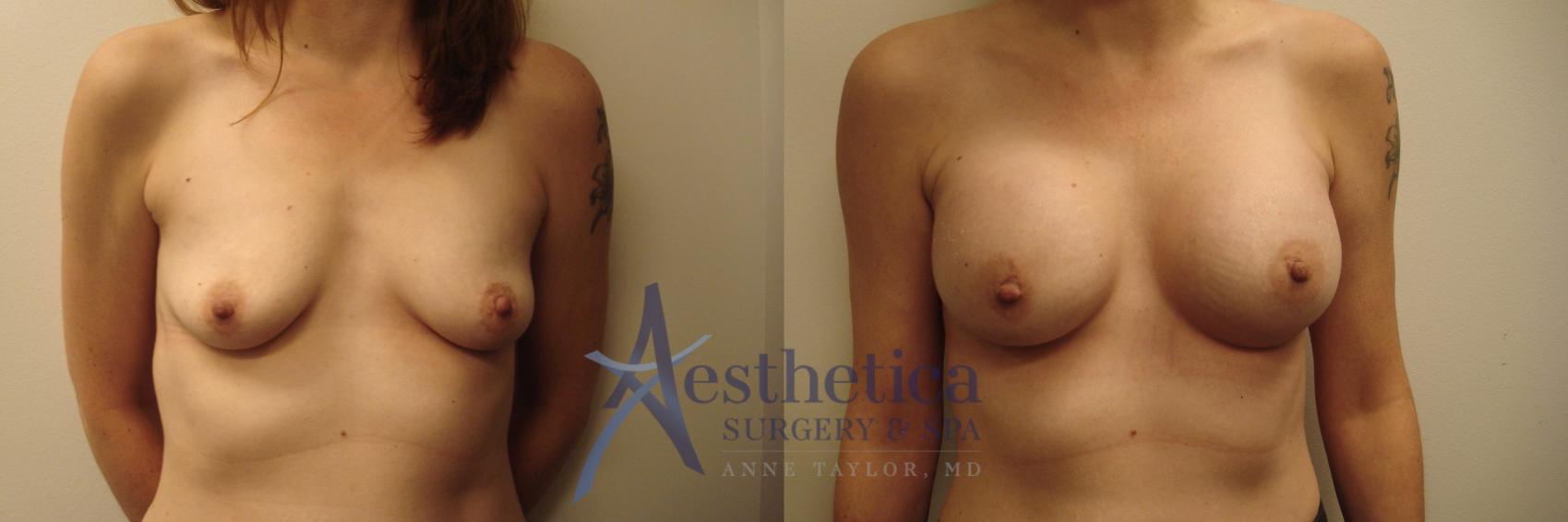 Breast Augmentation Case 656 Before & After Front | Columbus, OH | Aesthetica Surgery & Spa