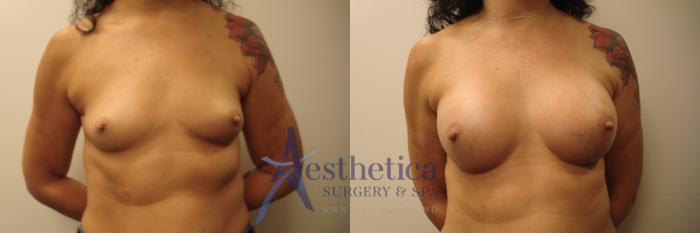 Breast Augmentation Case 673 Before & After Front | Columbus, OH | Aesthetica Surgery & Spa