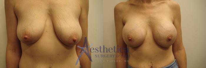Breast Augmentation Case 674 Before & After Front | Columbus, OH | Aesthetica Surgery & Spa