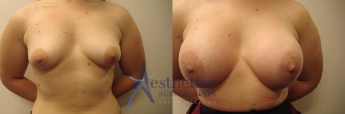 Breast Augmentation Case 675 Before & After Front | Columbus, OH | Aesthetica Surgery & Spa