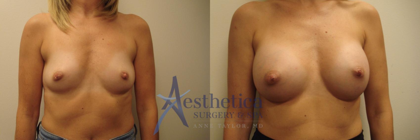 Breast Augmentation Case 679 Before & After Front | Columbus, OH | Aesthetica Surgery & Spa