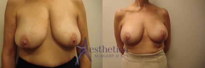 Breast Augmentation Case 683 Before & After Front | Columbus, OH | Aesthetica Surgery & Spa