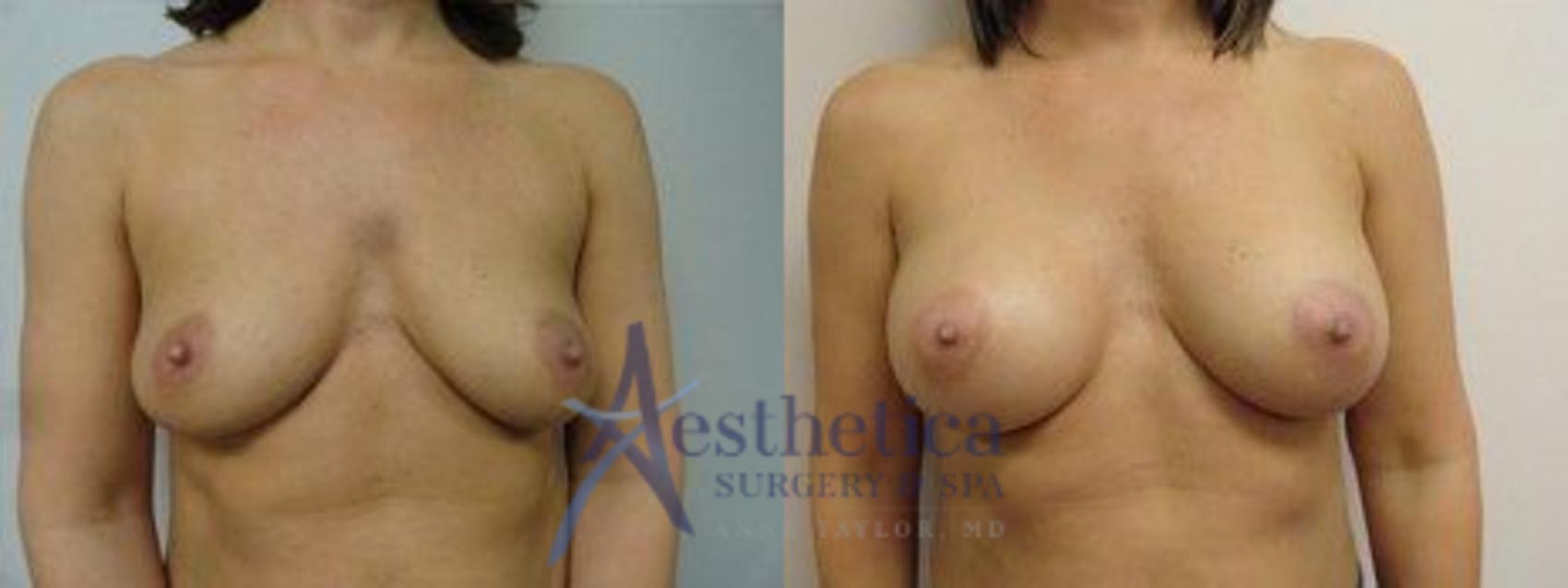 Breast Augmentation Case 7 Before & After View #1 | Worthington, OH | Aesthetica Surgery & Spa