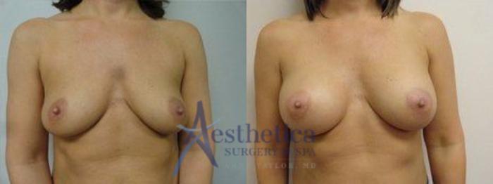 Breast Augmentation Case 7 Before & After View #1 | Columbus, OH | Aesthetica Surgery & Spa