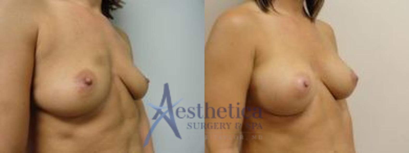 Breast Augmentation Case 7 Before & After View #2 | Worthington, OH | Aesthetica Surgery & Spa