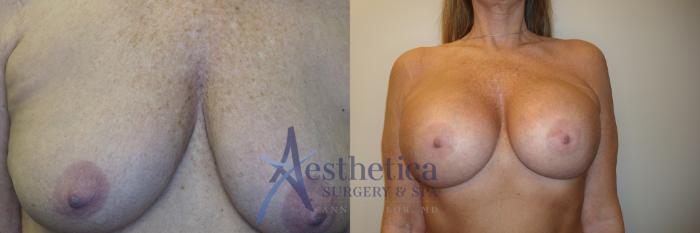 Breast Augmentation Case 770 Before & After Front | Columbus, OH | Aesthetica Surgery & Spa