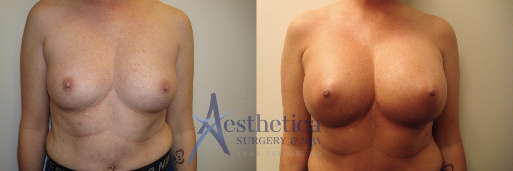 Breast Augmentation Case 779 Before & After Front | Columbus, OH | Aesthetica Surgery & Spa