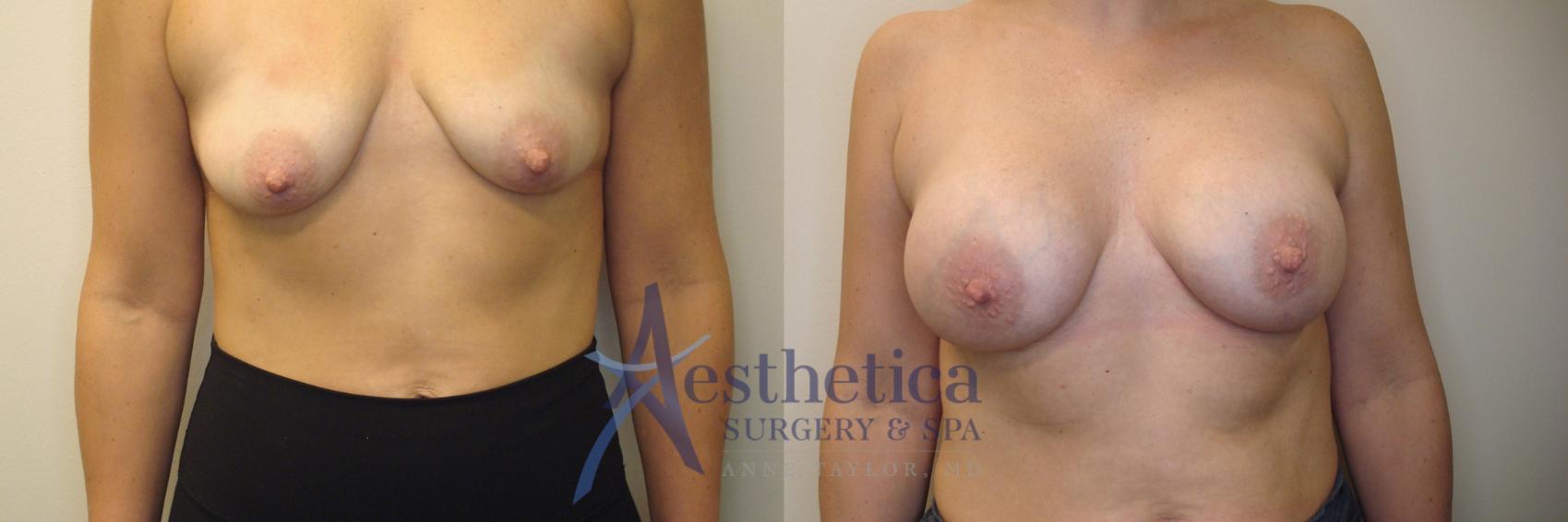 Breast Augmentation Case 780 Before & After Front | Columbus, OH | Aesthetica Surgery & Spa