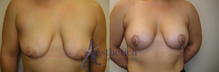 Breast Augmentation Case 782 Before & After Front | Columbus, OH | Aesthetica Surgery & Spa