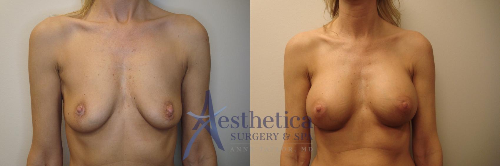 Breast Augmentation Case 785 Before & After Front | Columbus, OH | Aesthetica Surgery & Spa