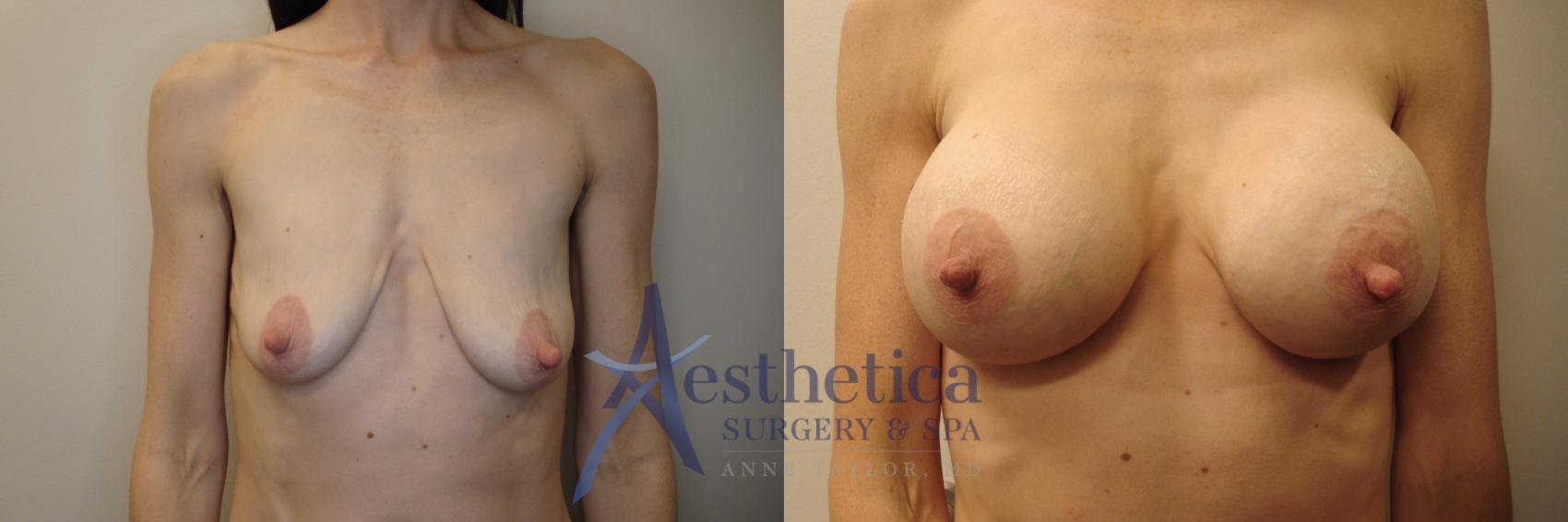 Breast Augmentation Case 792 Before & After Front | Columbus, OH | Aesthetica Surgery & Spa