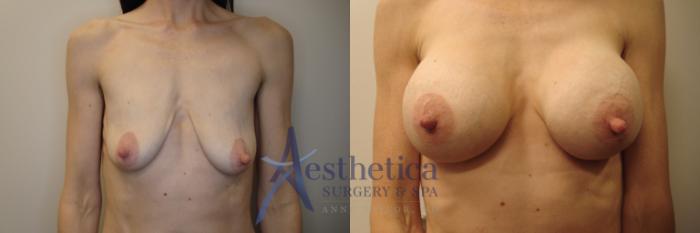 Breast Augmentation Case 792 Before & After Front | Columbus, OH | Aesthetica Surgery & Spa