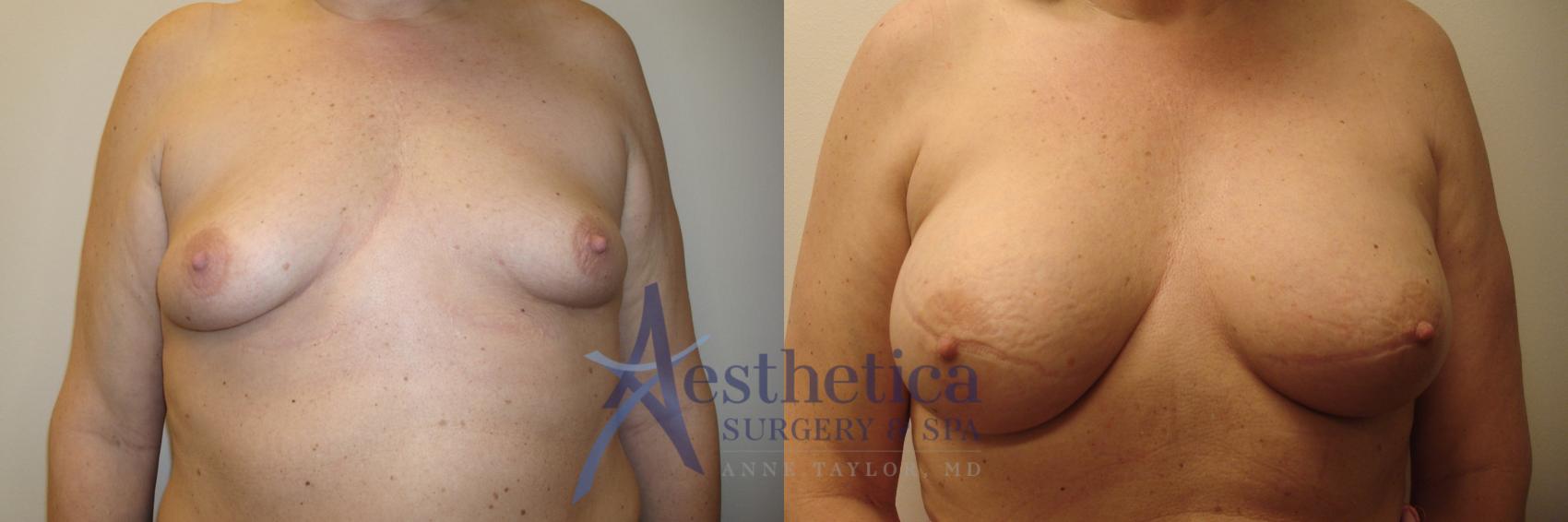 Breast Augmentation Case 794 Before & After Front | Columbus, OH | Aesthetica Surgery & Spa