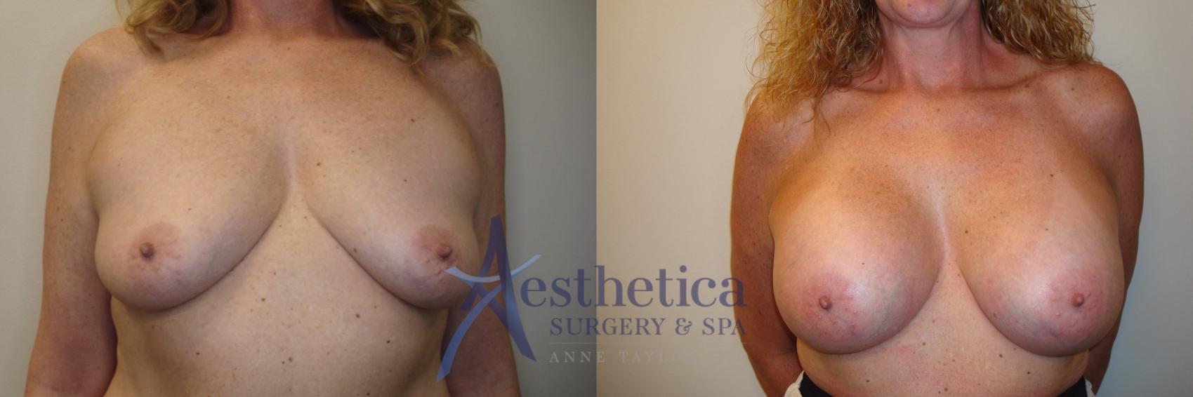 Breast Augmentation Case 803 Before & After Front | Columbus, OH | Aesthetica Surgery & Spa