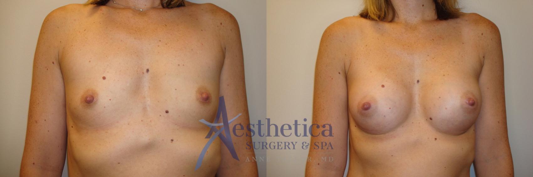 Breast Augmentation Case 807 Before & After Front | Columbus, OH | Aesthetica Surgery & Spa