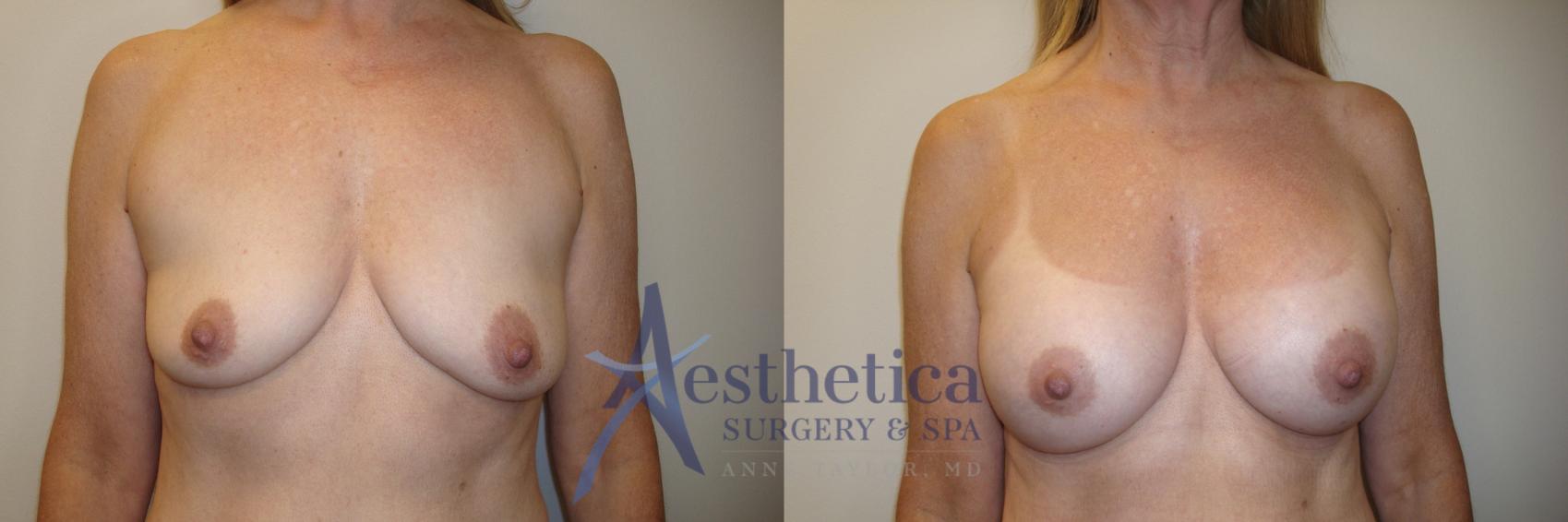 Breast Augmentation Case 810 Before & After Front | Columbus, OH | Aesthetica Surgery & Spa