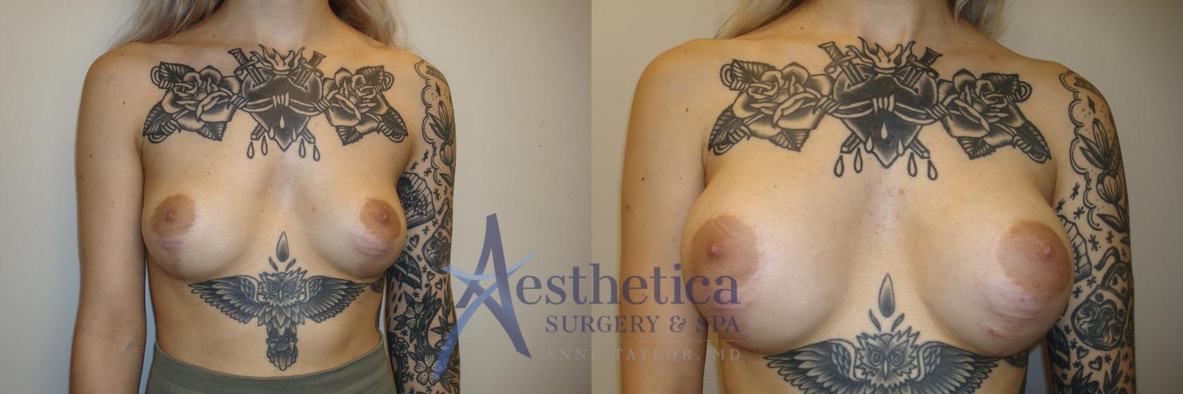 Breast Augmentation Case 811 Before & After Front | Columbus, OH | Aesthetica Surgery & Spa