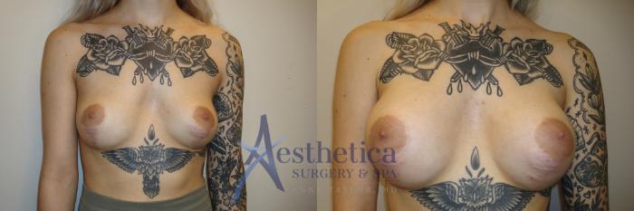 Breast Augmentation Case 811 Before & After Front | Columbus, OH | Aesthetica Surgery & Spa