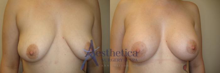 Breast Augmentation Case 812 Before & After Front | Columbus, OH | Aesthetica Surgery & Spa