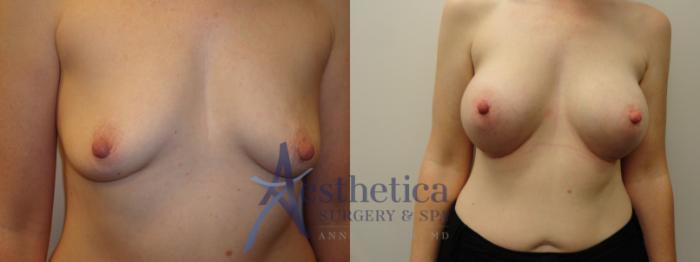 Breast Augmentation Case 818 Before & After Front | Columbus, OH | Aesthetica Surgery & Spa