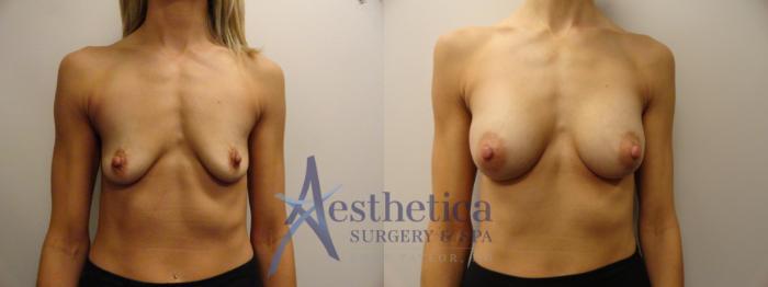 Breast Augmentation Case 833 Before & After Front | Columbus, OH | Aesthetica Surgery & Spa