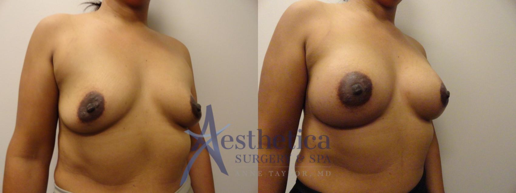 Breast Augmentation Case 866 Before & After Right Oblique | Columbus, OH | Aesthetica Surgery & Spa
