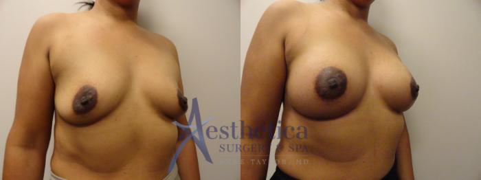 Breast Augmentation Case 866 Before & After Right Oblique | Columbus, OH | Aesthetica Surgery & Spa
