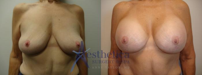 Breast Augmentation Case 875 Before & After Front | Columbus, OH | Aesthetica Surgery & Spa