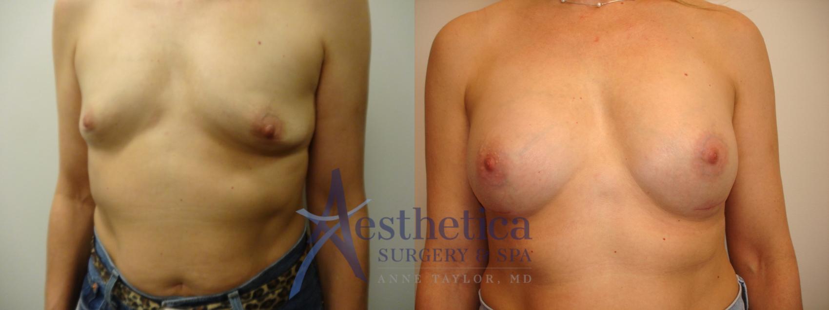 Breast Augmentation Case 876 Before & After Front | Columbus, OH | Aesthetica Surgery & Spa