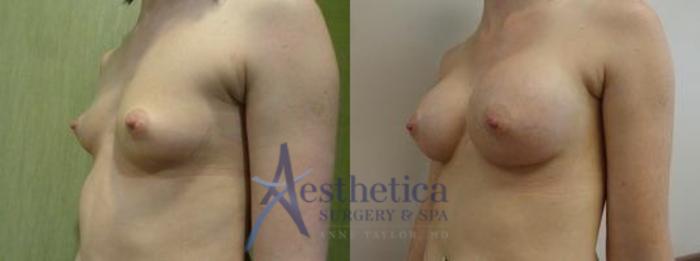 Breast Augmentation Case 9 Before & After View #1 | Columbus, OH | Aesthetica Surgery & Spa
