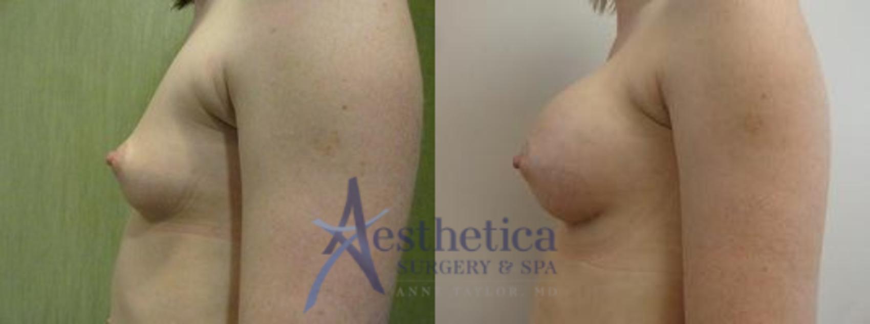 Breast Augmentation Case 9 Before & After View #2 | Worthington, OH | Aesthetica Surgery & Spa