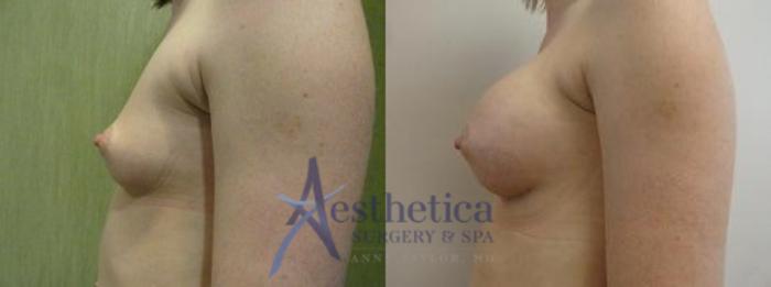 Breast Augmentation Case 9 Before & After View #2 | Columbus, OH | Aesthetica Surgery & Spa