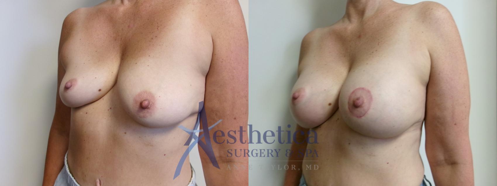 Breast Augmentation Case 912 Before & After Right Oblique | Columbus, OH | Aesthetica Surgery & Spa