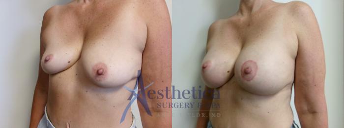 Breast Augmentation Case 912 Before & After Right Oblique | Columbus, OH | Aesthetica Surgery & Spa