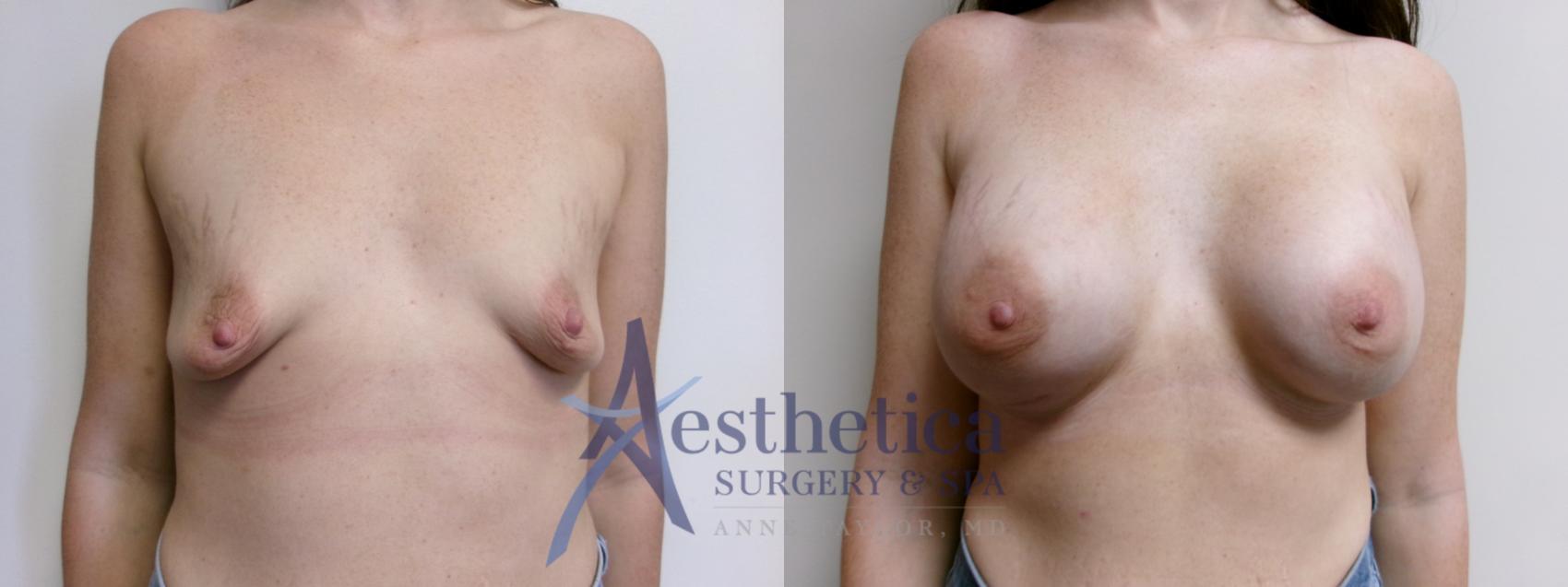 Breast Augmentation Case 915 Before & After Front | Columbus, OH | Aesthetica Surgery & Spa