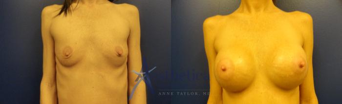 Breast Augmentation Case 95 Before & After View #1 | Columbus, OH | Aesthetica Surgery & Spa