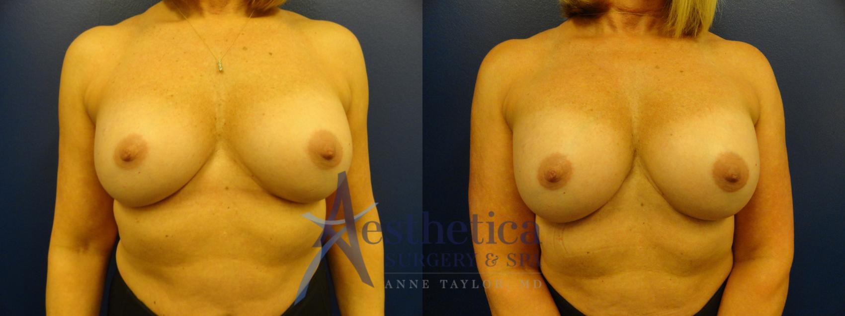 Breast Augmentation Revision Case 105 Before & After View #1 | Worthington, OH | Aesthetica Surgery & Spa