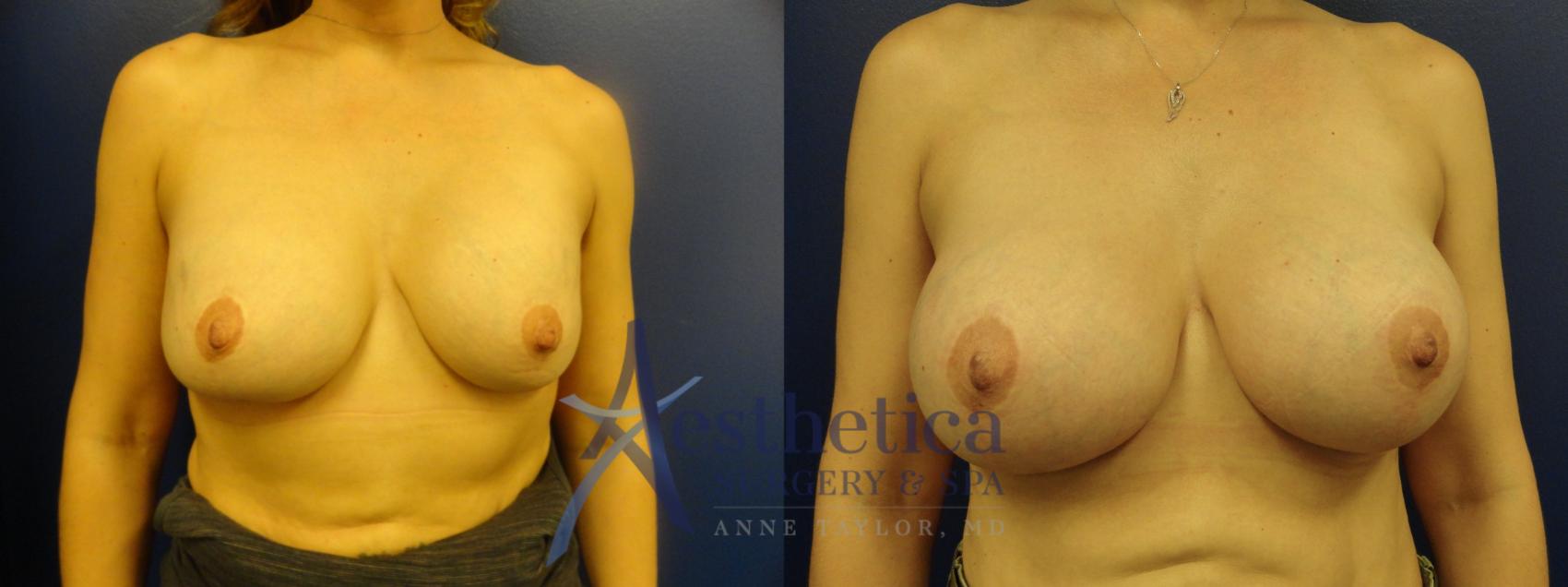 Breast Augmentation Revision Case 106 Before & After View #1 | Worthington, OH | Aesthetica Surgery & Spa