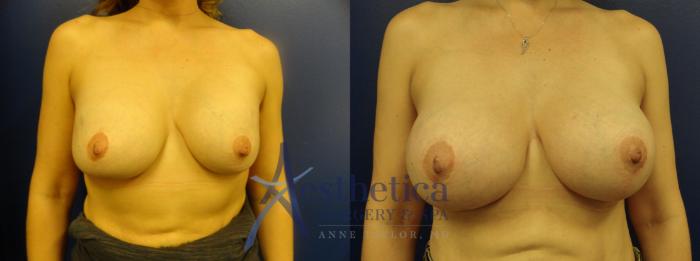Breast Augmentation Revision Case 106 Before & After View #1 | Columbus, OH | Aesthetica Surgery & Spa