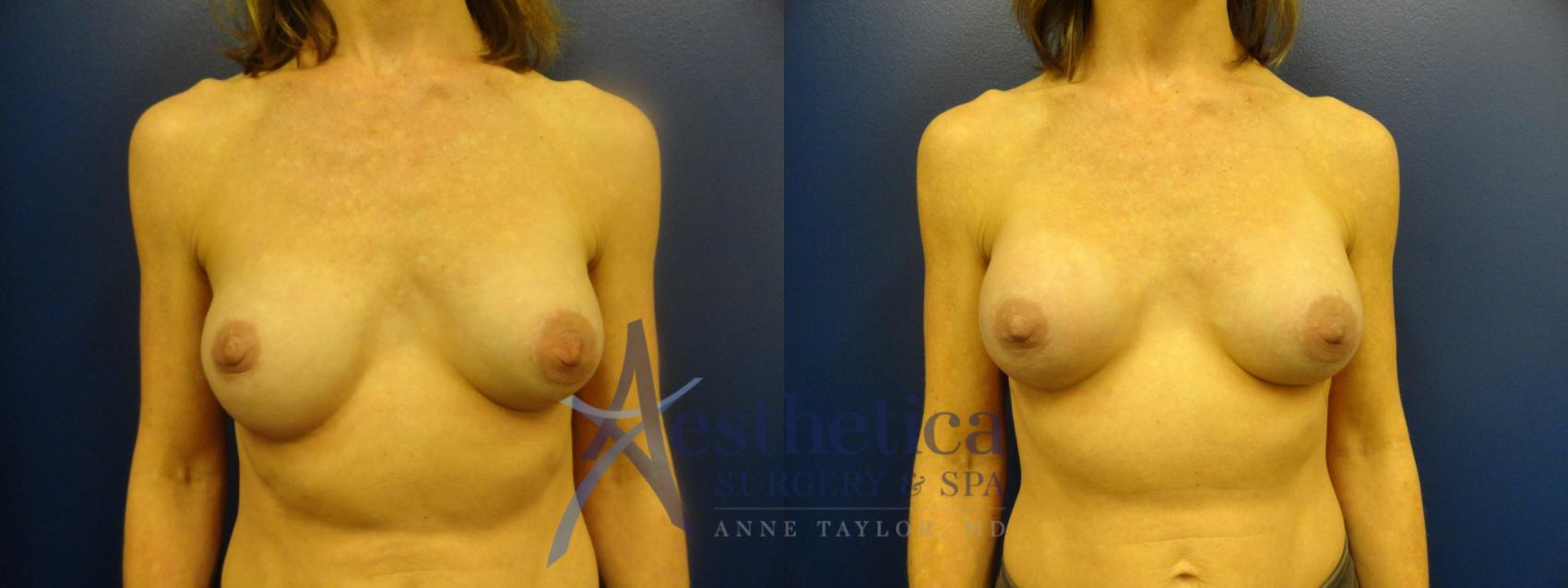 Breast Augmentation Revision Case 107 Before & After View #1 | Worthington, OH | Aesthetica Surgery & Spa